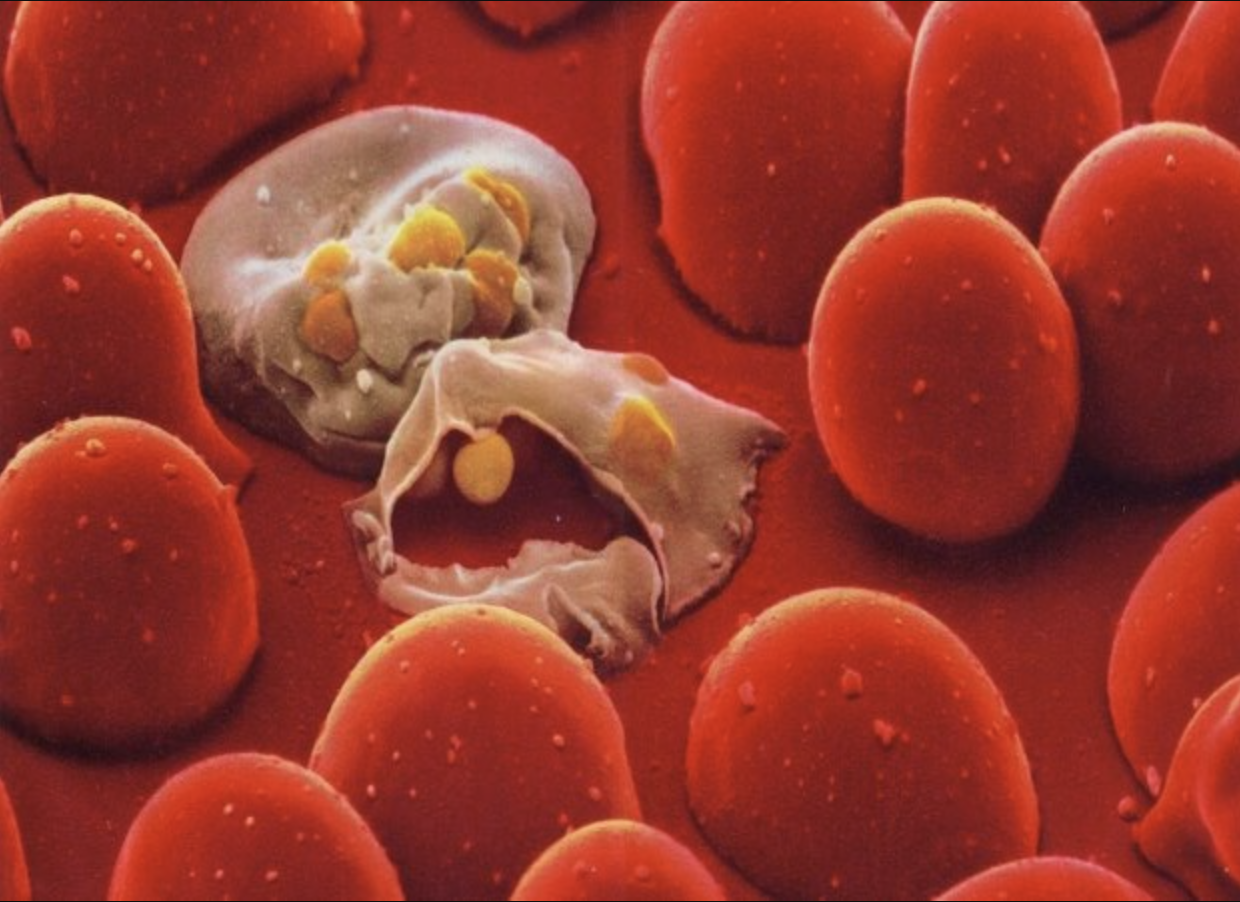 Tan máu bẩm sinh (Thalassemia): Nguyên nhân, triệu chứng và cách điều trị bệnh