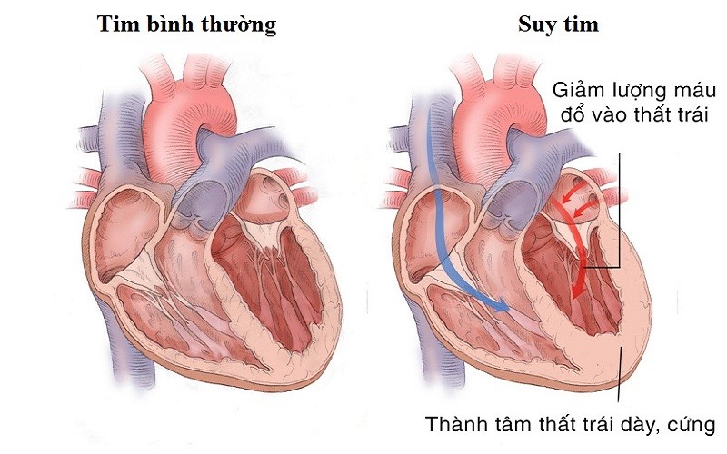 5 DẤU HIỆU SUY TIM DO CAO HUYẾT ÁP