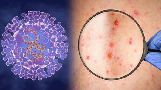 Xuất hiện ca bệnh đậu mùa khỉ chưa rõ nguồn lây ở Đồng Nai