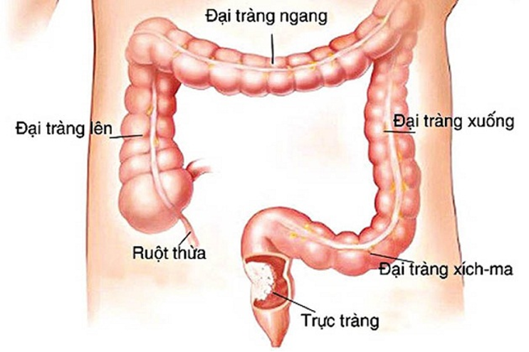 UNG THƯ ĐẠI TRỰC TRÀNG ĐANG TRẺ HÓA TẠI VIỆT NAM