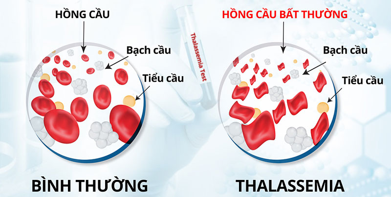 Quận Tân Bình triển khai các hoạt động truyền thông hưởng ứng Ngày Thalassemia thế giới 08/5 với chủ đề: “Chung tay đẩy lùi bệnh tan máu bẩm sinh vì sức khỏe cộng đồng, vì tương lai nòi giống”