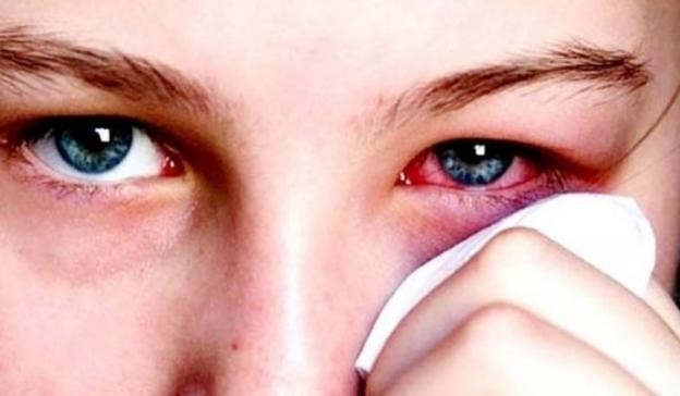 Đau mắt đỏ quay trở lại sau khi vắng bóng trong dịch COVID-19, cần lưu ý gì?