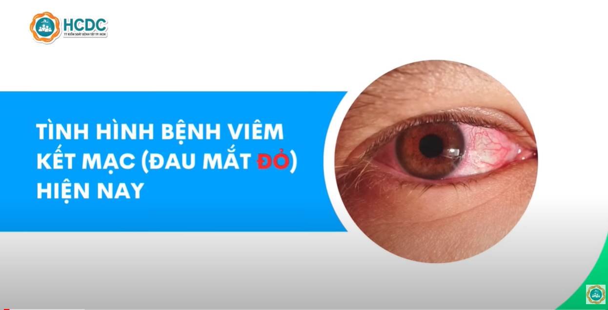 Đau mắt đỏ cần lưu ý điều gì ?