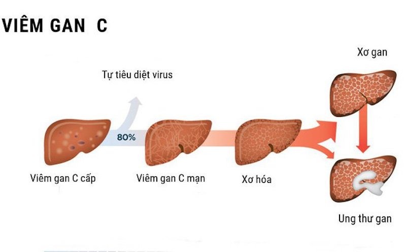 Viêm gan C lây như thế nào?